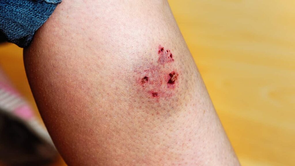 Evidence of a dog bite manifests as puncture marks and bruising on a woman's leg.